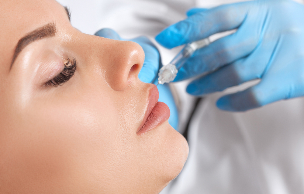 Smile Lines (Nasolabial Folds)